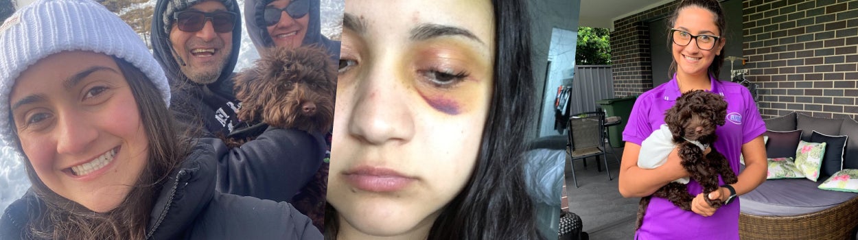 Young woman in a beanie smiling with people. Woman with a bruised eye post brain cancer surgery. Young woman with glasses in purple shirt smiling with her dog